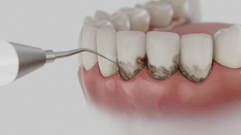 Trusted Wisdom Tooth Removal service in Cowpens, SC - Dentist Open Now